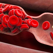 Blood Clot