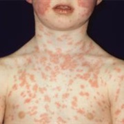 Fifth Disease
