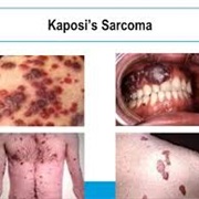 Kaposi's Sarcoma