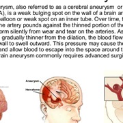 Brain Aneurysm