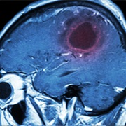Benign Brain Tumour (Non-Cancerous)