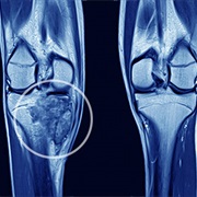 Bone Cancer