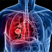 Lung Cancer