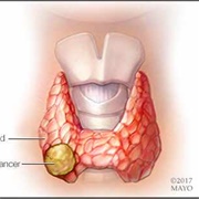 Thyroid Cancer