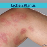 Lichen Planus