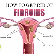 Fibroids