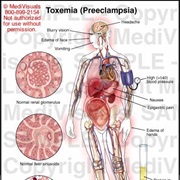 Toxemia