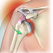 Dislocated Shoulder