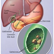 Gallstones