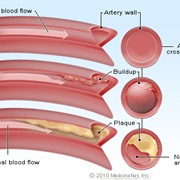 Blocked Artery