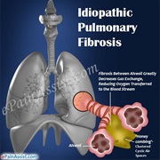 Idiopathic Pulmonary Fibrosis