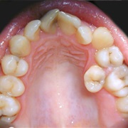 Dental Overcrowding
