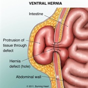 Hernia
