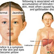 Jaundice