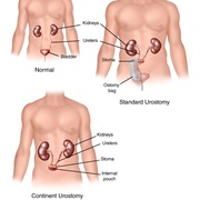Urostomy