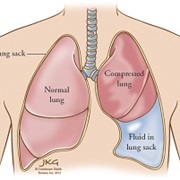 Pulmonary Edema