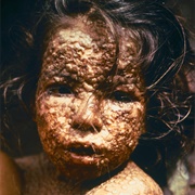 Smallpox