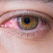 Conjunctivitis