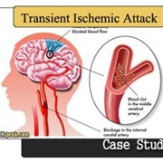 Transient Ischaemic Attack (TIA)