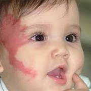 Strawberry Birthmark