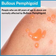 Bullous Pemphigoid