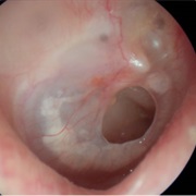 Perforated Ear Drum