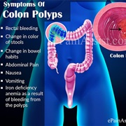Bowel Polyps