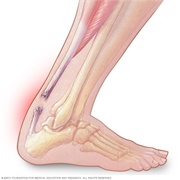 Achilles Tendon Tear