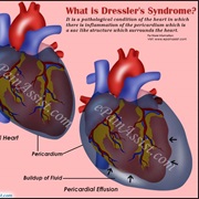 Dressler's Syndrome