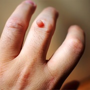 Humans Catch Warts From Toads/Animals