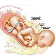 Umbilical Cord Entanglement