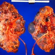 Autosomal Dominant Polycystic Kidney Disease