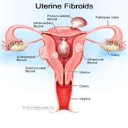 Fibroid