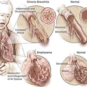 Emphysema