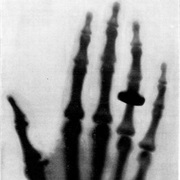 The Hand of Mrs Wilhelm Rontgen