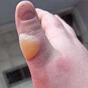 Blister