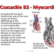 Coxsackie Myocarditis