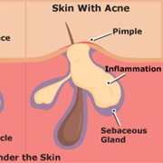 Chocolate Gives You Acne