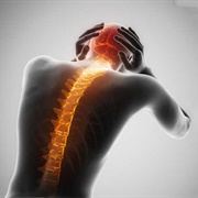Spinal Headaches