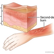 Second Degree Burns