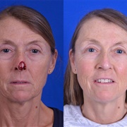 Reconstructive Surgery