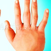 Complex Regional Pain Syndrome (CRPS)