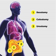 Ostomy