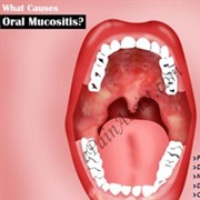 Mucositis