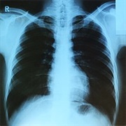 Xray