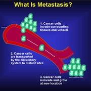 Metastasis