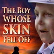 The Boy Whose Skin Fell Off