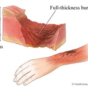 Third Degree Burns