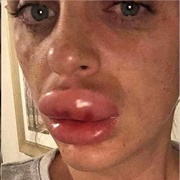 Plastic Surgery Goes Wrong