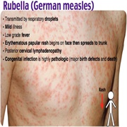 German Measles